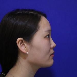 整形前后对比图片