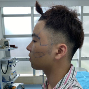 整形前后对比图片