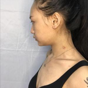 整形前后对比图片