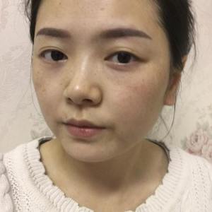 整形前后对比图片