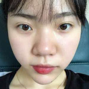 整形前后对比图片