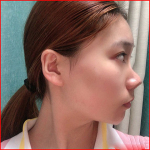 整形前后对比图片