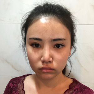 整形前后对比图片