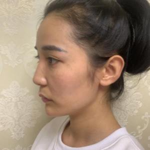 整形前后对比图片