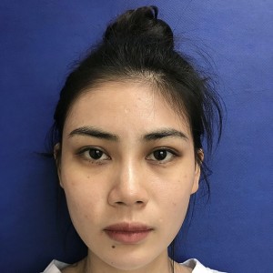 整形前后对比图片