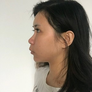 整形前后对比图片