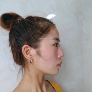 心静而欣的整形术后图片