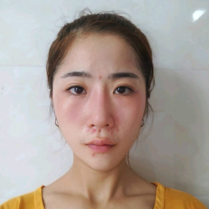 心静而欣的整形术后图片