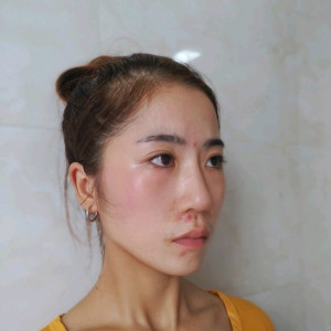 心静而欣的整形术后图片