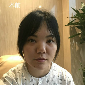 整形前后对比图片