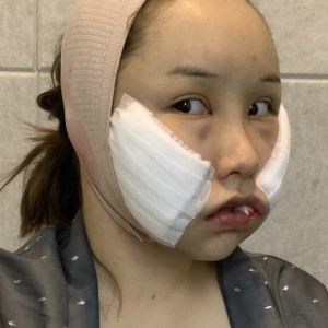 地球是圆的的整形术后图片