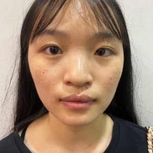 整形前后对比图片