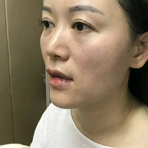 整形前后对比图片