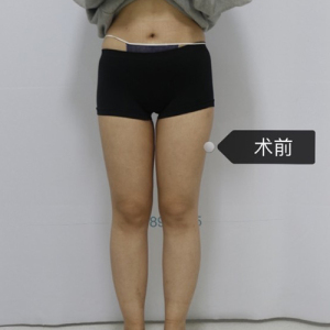 整形前后对比图片