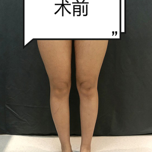 整形前后对比图片