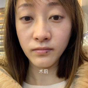 整形前后对比图片