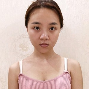 整形前后对比图片