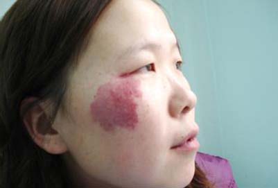 激光去胎记的危害有哪些 激光去胎记有6大危害知道的人很少