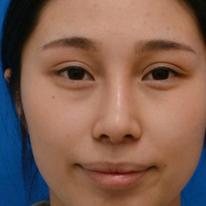 整形前后对比图片