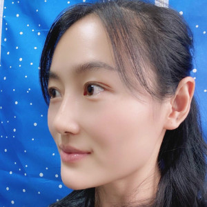 低调的、凤凰的整形术后图片