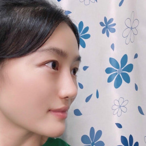 低调的、凤凰的整形术后图片