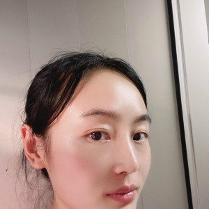 低调的、凤凰的整形术后图片