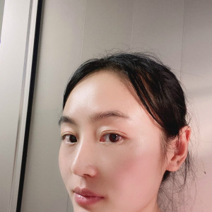 低调的、凤凰的整形术后图片