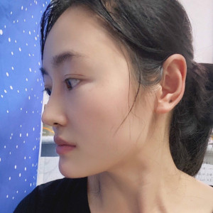 低调的、凤凰的整形术后图片