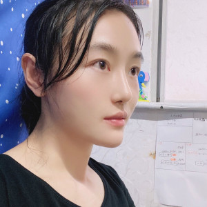 低调的、凤凰的整形术后图片