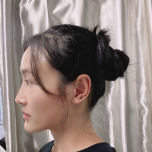 低调的、凤凰的整形术后图片