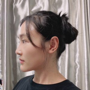 低调的、凤凰的整形术后图片