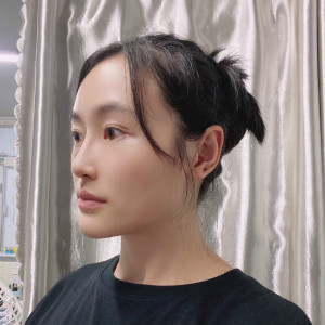 低调的、凤凰的整形术后图片