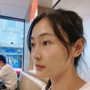 低调的、凤凰的整形术后图片