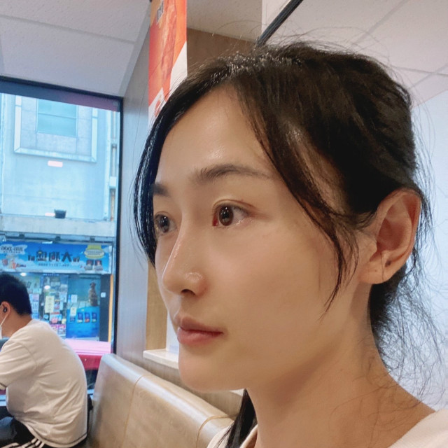 低调的、凤凰的整形术后图片