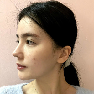 整形前后对比图片