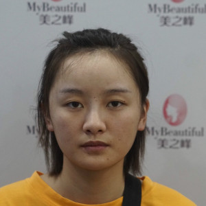 整形前后对比图片