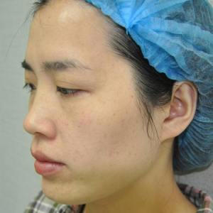 整形前后对比图片