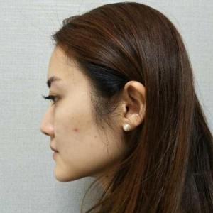 整形前后对比图片