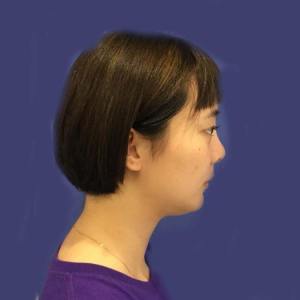 整形前后对比图片