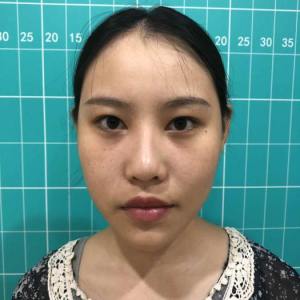 整形前后对比图片