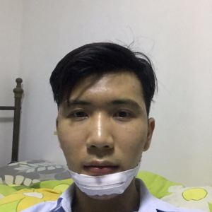 谁说我bu在、的整形术后图片