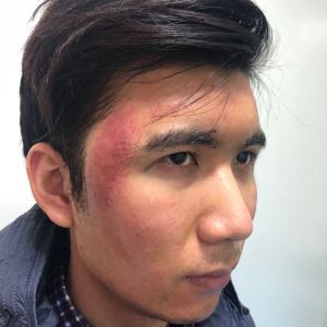 谁说我bu在、的整形术后图片