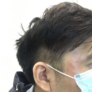 谁说我bu在、的整形术后图片