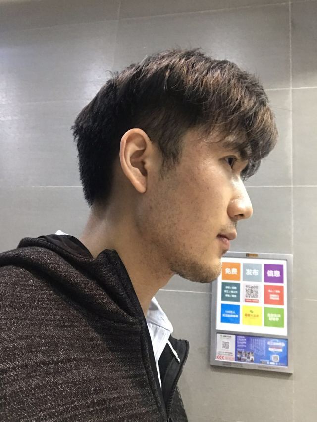 谁说我bu在、的整形术后图片