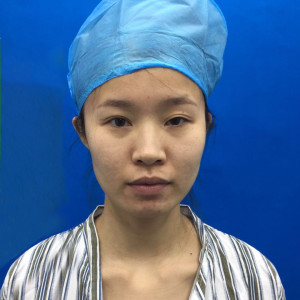 整形前后对比图片