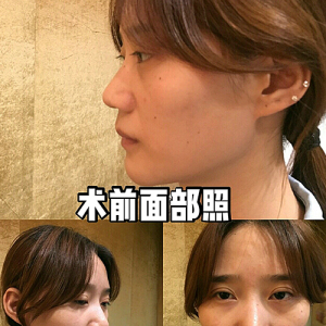 整形前后对比图片