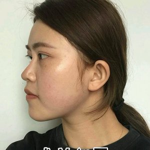 整形前后对比图片