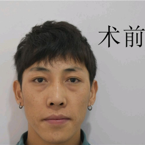 整形前后对比图片