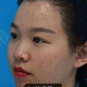 整形前后对比图片