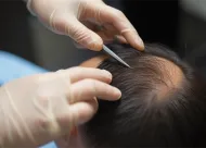男性脫發(fā)治療：有效解決方法
